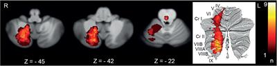 Determinants of functioning and health-related quality of life after vestibular stroke